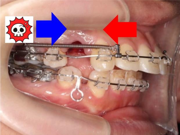 歯科矯正用アンカースクリューのメリット2