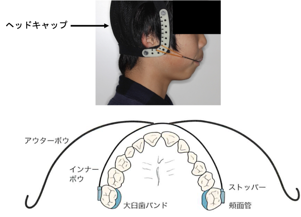 ヘッドギア|奈良の矯正歯科なら【おとなとこどもの歯並び 中山矯正歯科・小児歯科 西大寺】